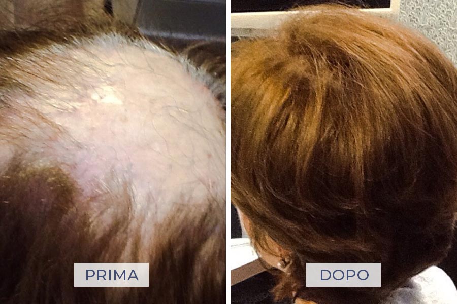 infoltimento-hairdream-prima-dopo